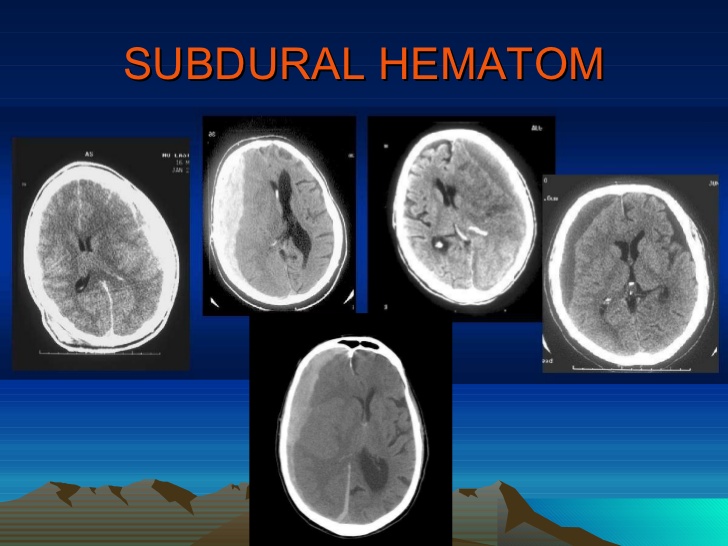 subdural kanama-28261