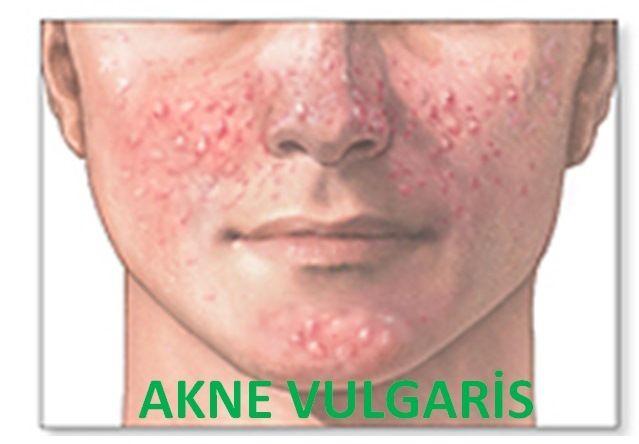 akne vulgaris-27965