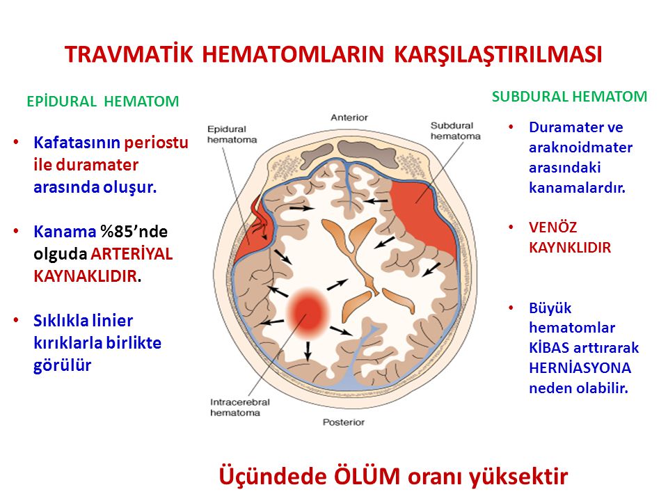 subdural kanama-28262