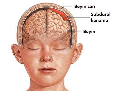subdural kanama-8235