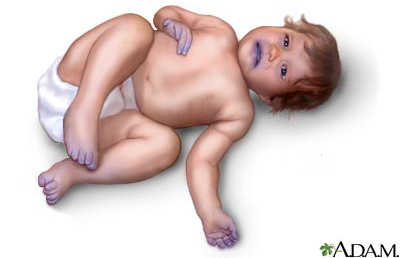 mavi bebek sendromu-4015