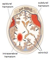 subdural kanama-28257
