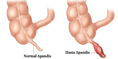 apandisit-5192