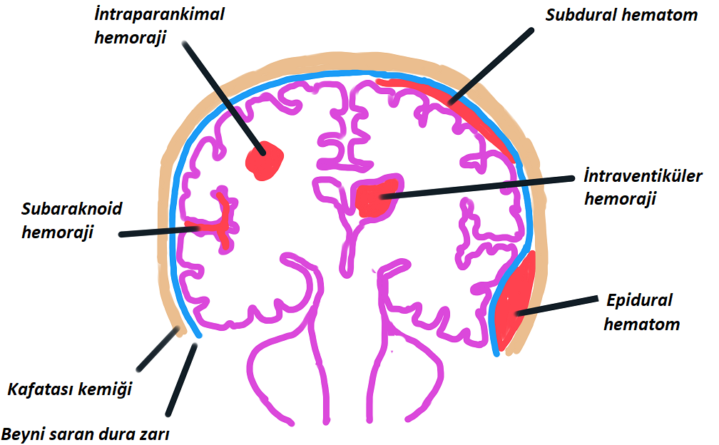 subdural kanama-28259