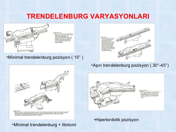 trendelenburg pozisyonu-29296