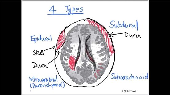 subdural kanama-28256
