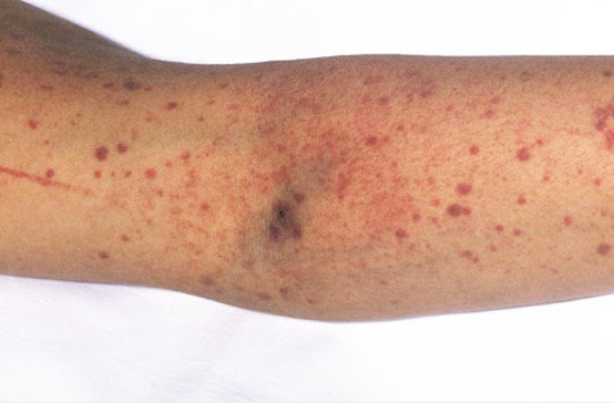 idiopatik trombositopenik purpura-29172