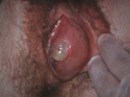 bartholin kisti_30768
