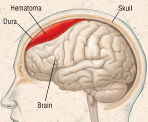 subdural kanama-28260