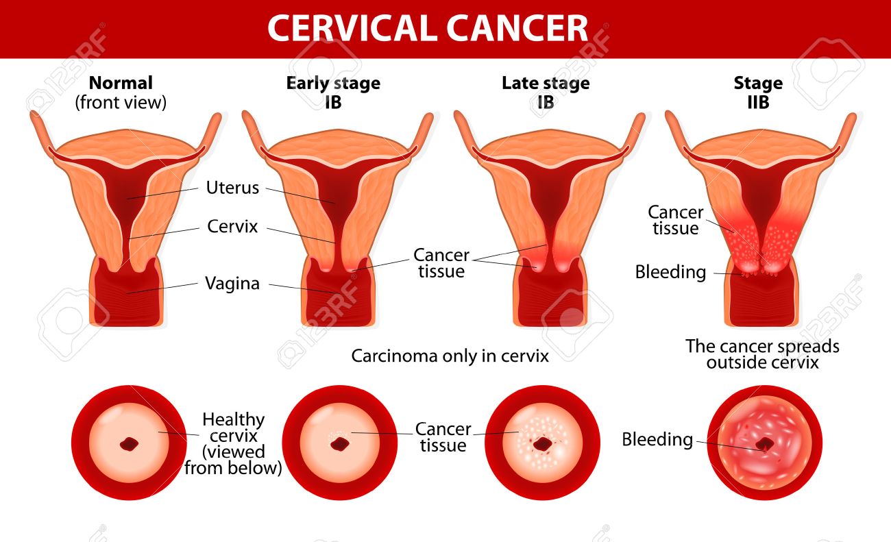 serviks uteri-22021